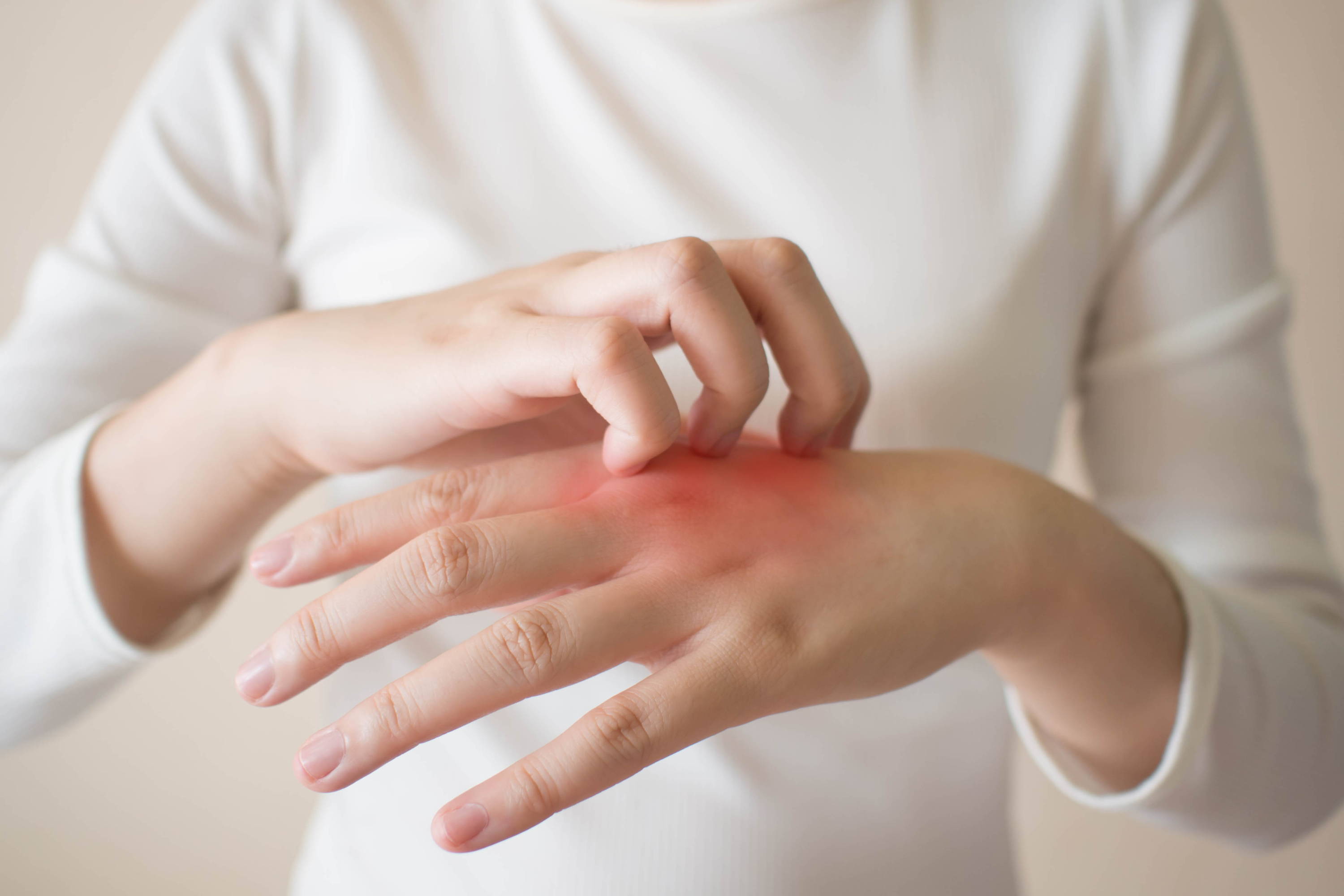 汗疹濕疹舒癢啫喱 Sweat Rash And Eczema Soothing Gel